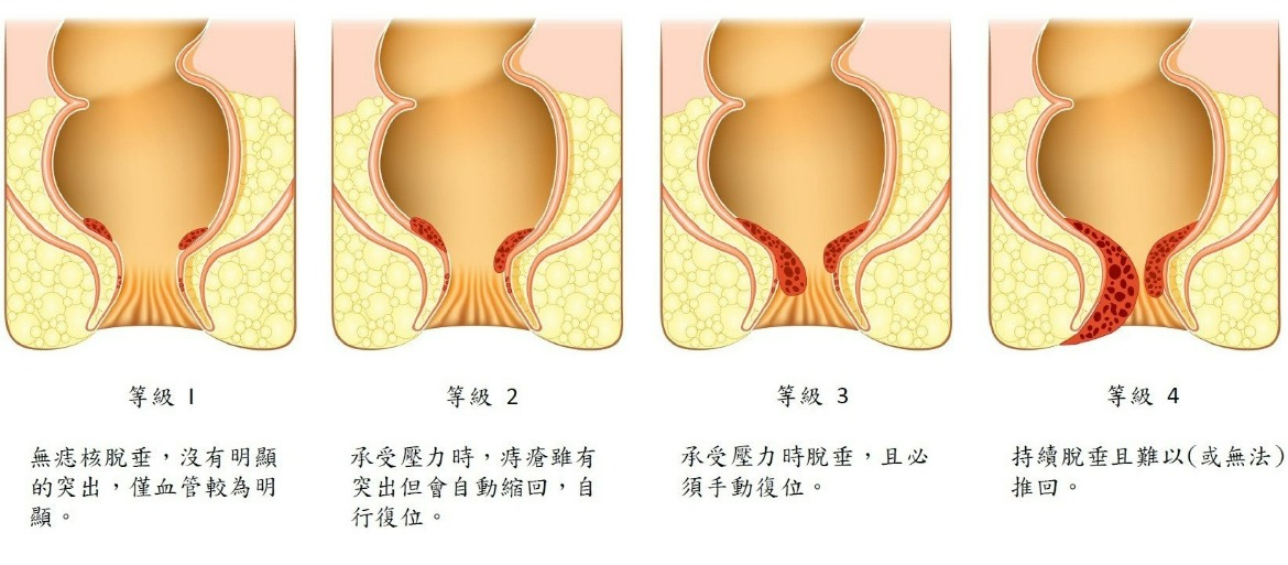 內痔分級